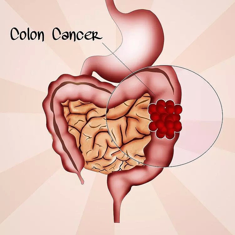 肠癌多是“拖”出来的，身体出现4种不适，肠道或已“病”得不轻（组图） - 1