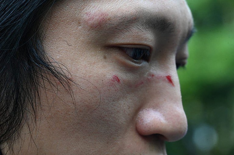 遇袭受伤的香港示威者Bob，脸上留有伤痕。 （示威主办方提供）