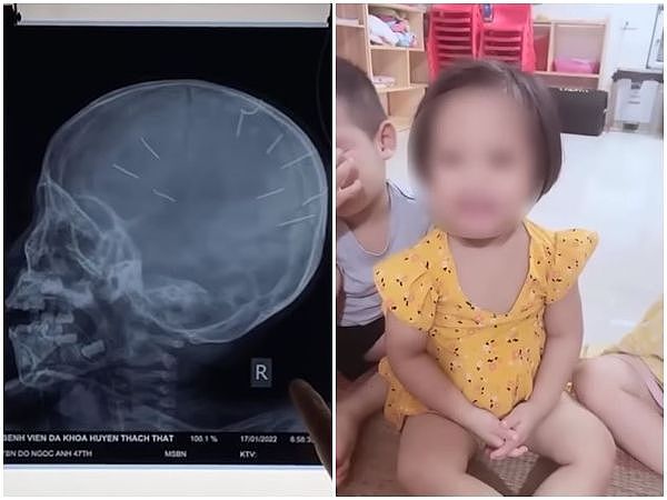 ▲▼越南河内30岁男子杀害女友的3岁女儿，X光扫描发现女童头骨内嵌入9根钉子。 （图／翻摄自YouTube、推特）