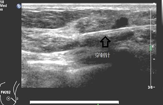 中国女子胸前溢血半年多，一查竟是这种癌，难以接受（组图） - 2