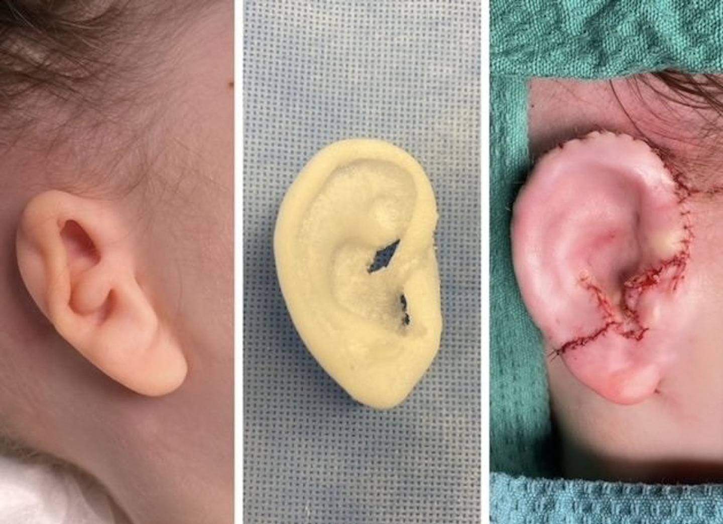 澳洲女童天生单耳近乎失聪，3D打印耳朵重建手术恢复听觉！妈妈：她非常勇敢（组图） - 3