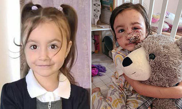 英5岁女孩被邻居家斗牛犬撕去脸上大片肌肉，手术三次，不敢出门（组图） - 1