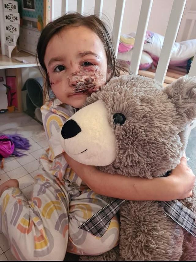 英5岁女孩被邻居家斗牛犬撕去脸上大片肌肉，手术三次，不敢出门（组图） - 3
