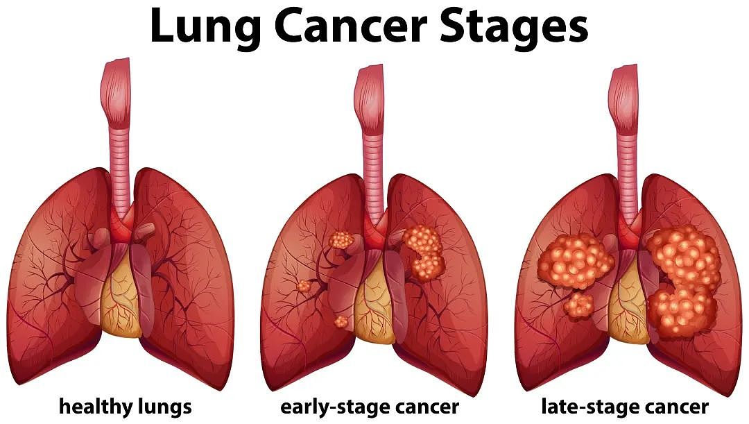 西澳每月有超100人查出肺癌，包括未吸烟者，快来自查（组图） - 3
