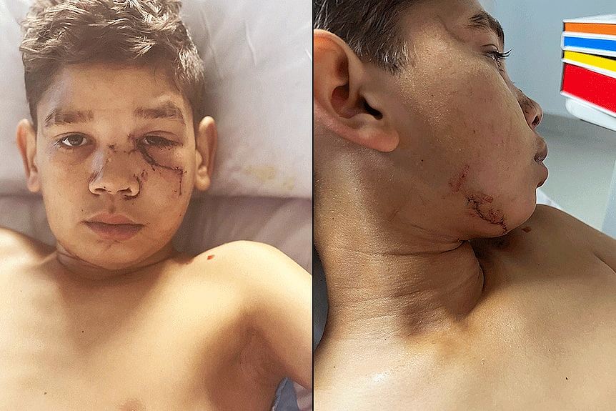 珀斯警方放警犬抓捕嫌犯，13岁男孩咬成重伤（组图） - 3