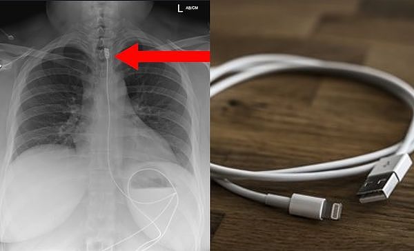 女呼吸困難緊急送醫　X光照發現「1公尺長iPhone充電線」卡在體內。（合成圖／取自Facebook與免費圖庫Pixabay）。
