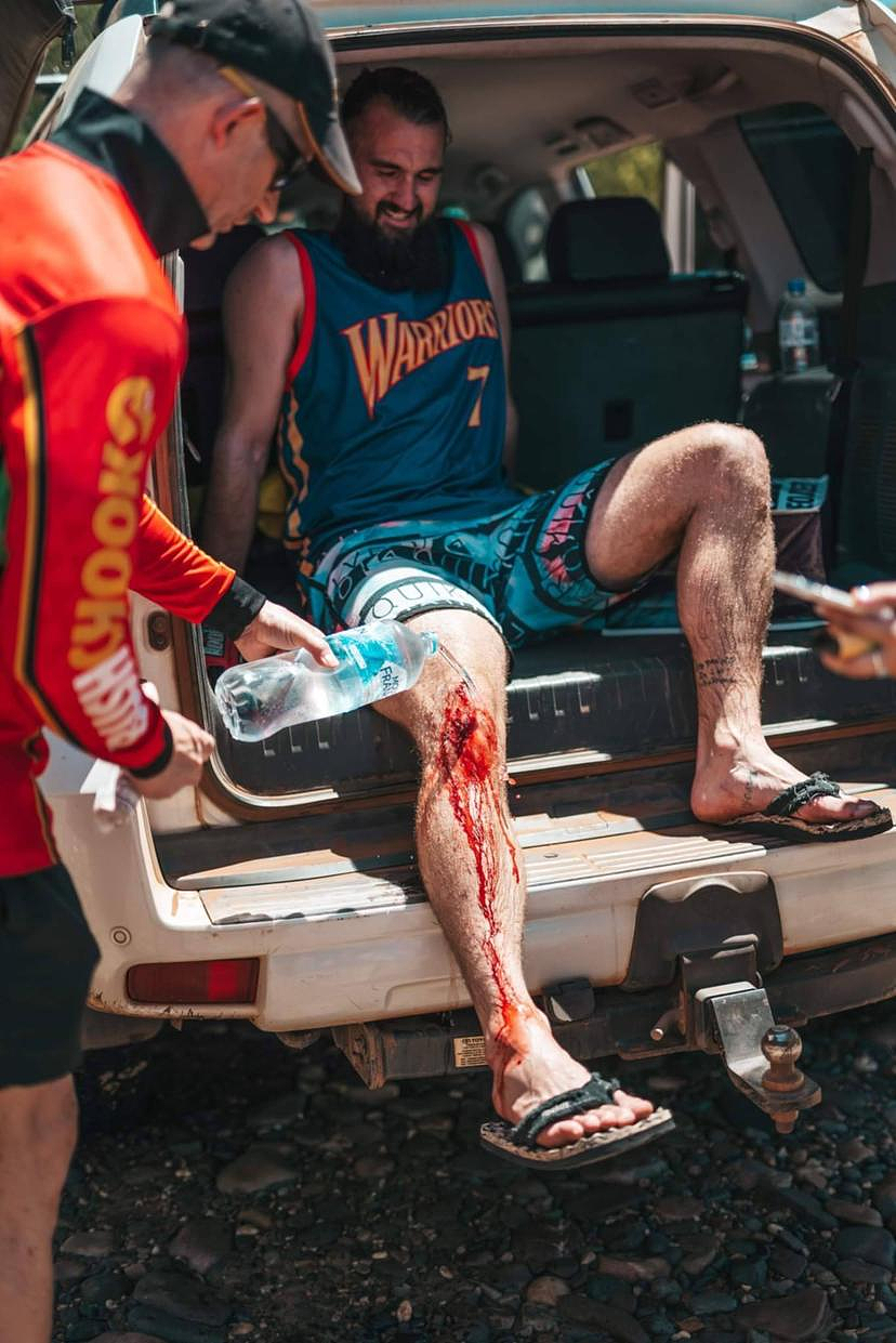 西澳男游泳遭鳄鱼咬，伤后微笑竖拇指回应（组图） - 3