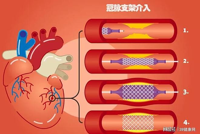 【健康】复涨70倍！心脏支架费用涨回万元时代，富了谁的荷包（组图） - 2