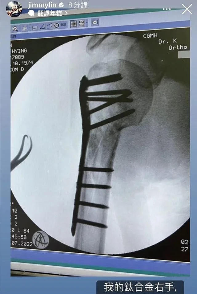 林志颖手臂X光片公开：骨头上插满10颗钉子，说不痛是骗人的（组图） - 3
