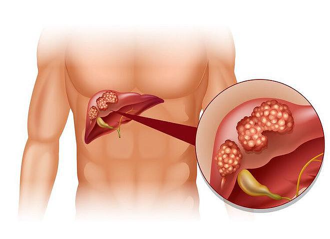 【健康】肝癌发出的第一个信号，通常出现在腹部，不少人却当成胃病了（组图） - 1