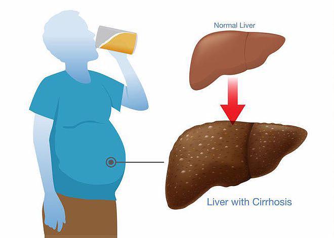 【健康】肝癌发出的第一个信号，通常出现在腹部，不少人却当成胃病了（组图） - 3