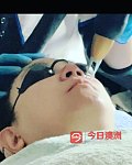 三次皮秒去斑療程特價