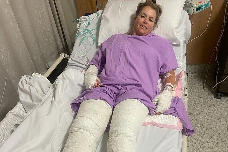 Elmarie Steenberg lies in a hospital bed with her legs in plasters.