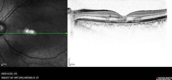 20岁女孩感染新冠3天后几近失明，确诊视网膜病变（图） - 2
