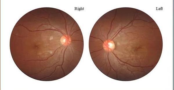 20岁女孩感染新冠3天后几近失明，确诊视网膜病变（图） - 1