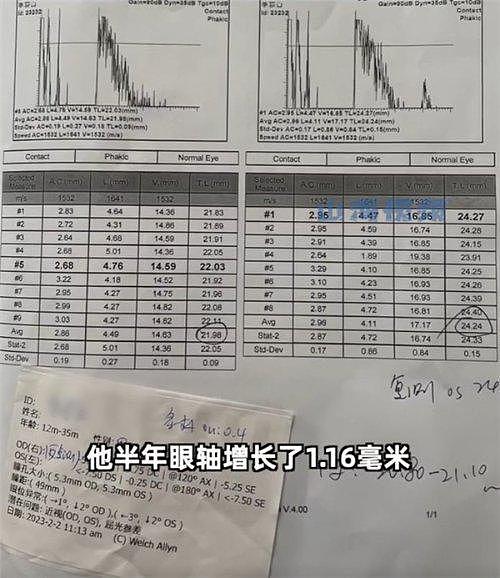 父母高度近视，1岁婴儿近视600度！恶化快速可能失明（组图） - 2