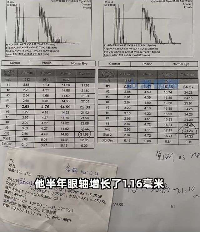 父母高度近视，1岁婴儿近视600度！恶化快速可能失明（组图） - 7