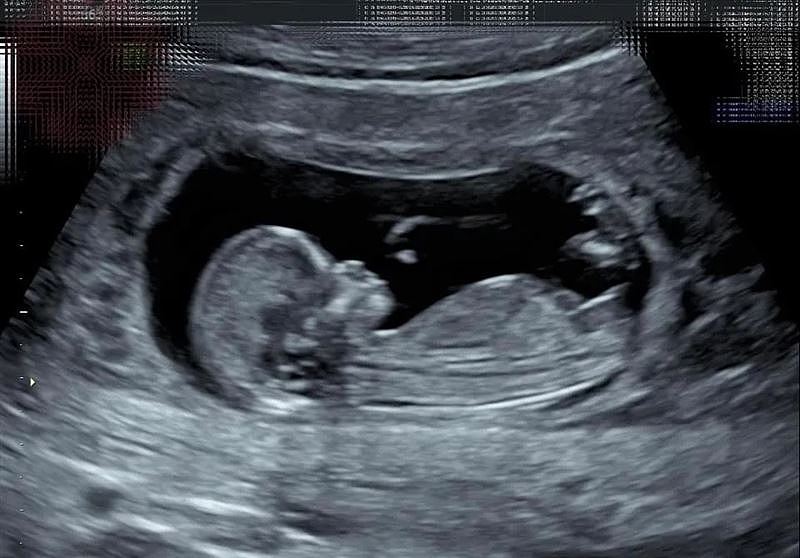 Selina大方公布肚中寶寶的超音波照，表示寶貝取名為「小腰果」。（圖／翻攝自Selina IG）