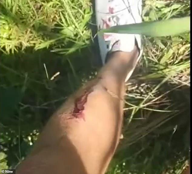 The learner pilot emerged from the wreck disorientated with a broken leg and posted his experience on social media (pictured, his leg injury from the ordeal)