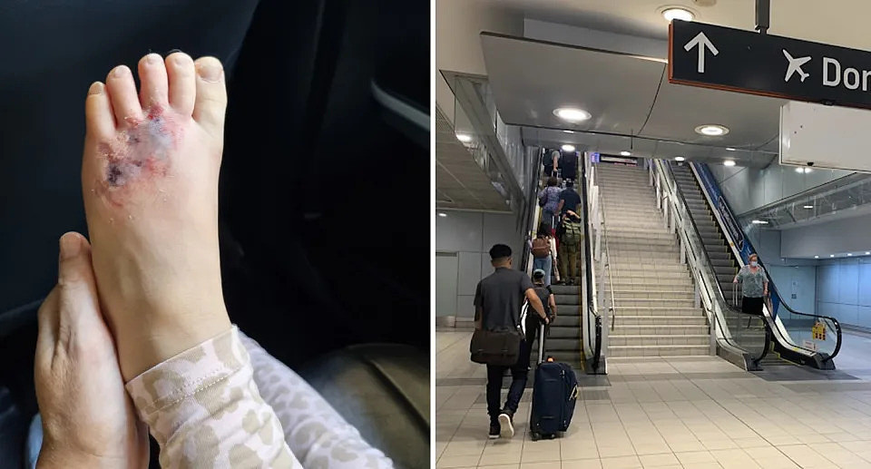 一张四岁孩子脚部瘀伤的照片，他的鳄鱼被卡在了悉尼国内机场通往火车的自动扶梯的一侧。