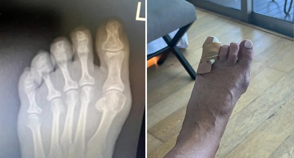 左边，可以看到维珍乘客脚部的 X 光片。 右图，可以看到凯·舒巴赫 (Kay Schubach) 的左脚最小的脚趾上缠着绷带。