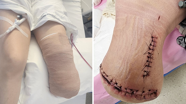 可怕！悉尼女子被蜘蛛咬伤，12周内伤势恶化，最终截肢保命（组图） - 3