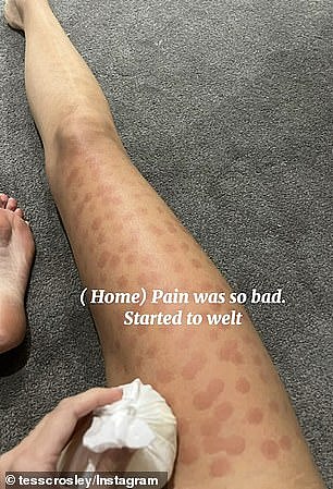 After arriving home from the appointment, Tess was in dreadful pain and the spots started to welt, so she applied ice over the skin and took cold showers for 'hours'