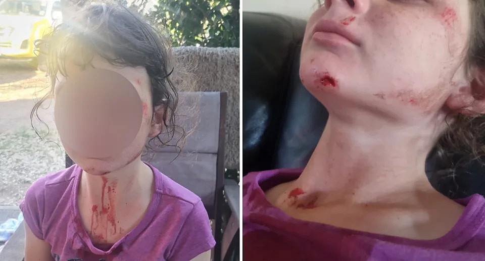 The council footpath caused the young resident to fall offer her scooter, injuring her face with scratches and open wounds (right) with blood over her neck (left). 