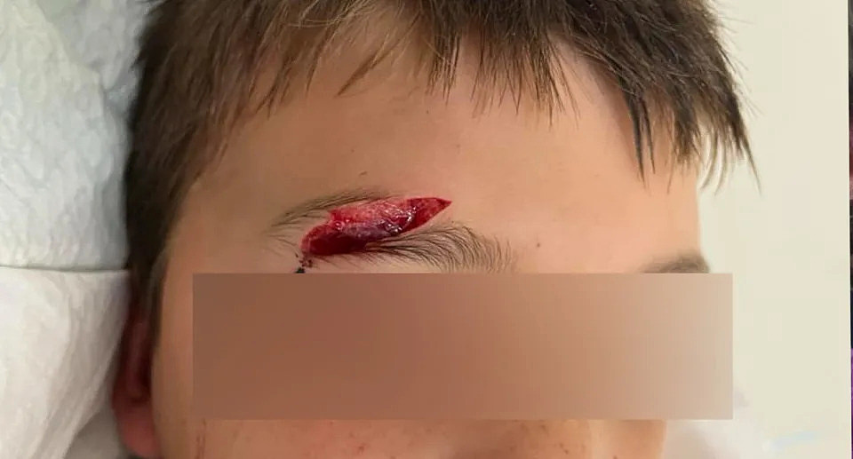 A young boy can be seen lying on a bed with a deep gash on his eyebrow. 
