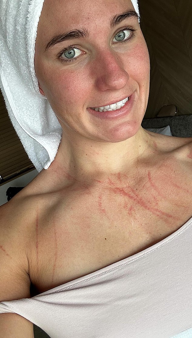 Australian water polo star Tilly Kearns has displayed her graphic injuries (pictured) following a recent match against China at the World Aquatics Championships in Japan