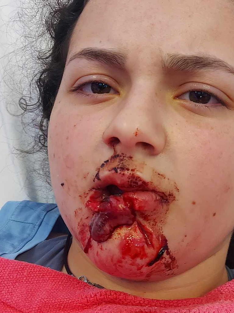 可怕！澳12岁女孩亲吻爱犬遭反咬，嘴唇被扯下大块...（组图） - 3