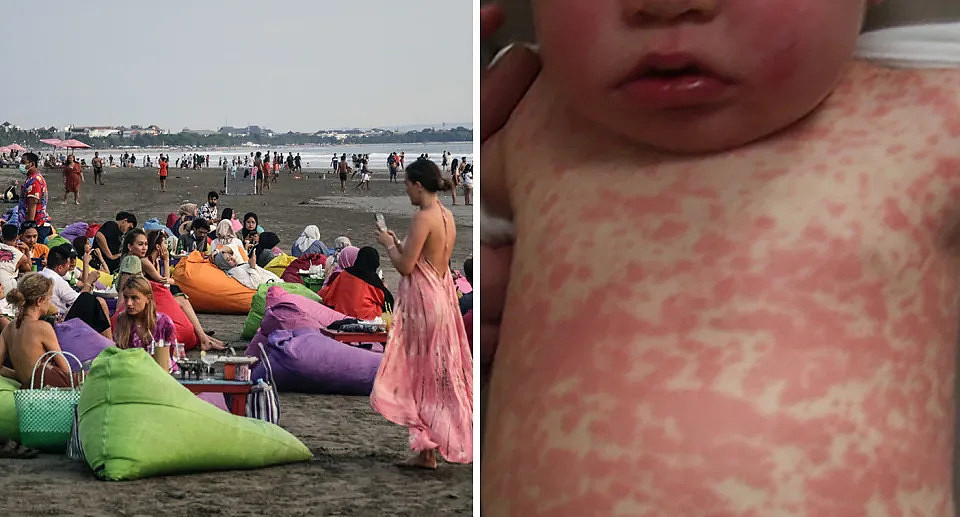 Tourists on Bali beach; Baby with measles