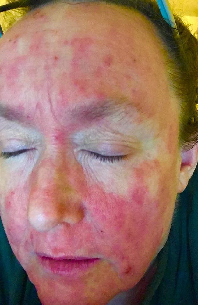 Faye Haines has been suffering from eczema since she was a baby. Picture: Supplied