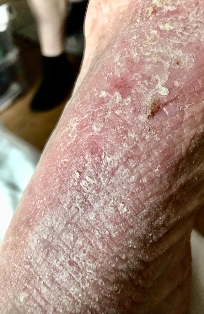 The 52-year-old said her skin is intensely itchy, sore and cracked. Picture: Supplied