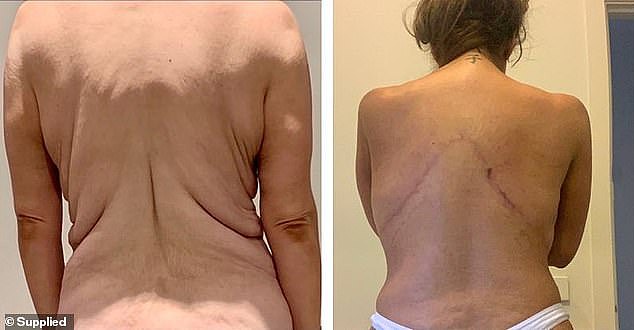 Kikii underwent three rounds of surgery, which cost her upwards of $100,000. She also got her breasts done as a 'little gift' to herself. (Pictured: Kikii's back before and after the surgeries)