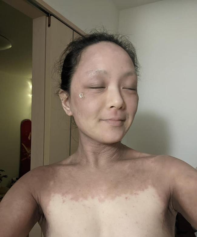 Belle says the discolouration on her skin was a ‘sign of improvement’.