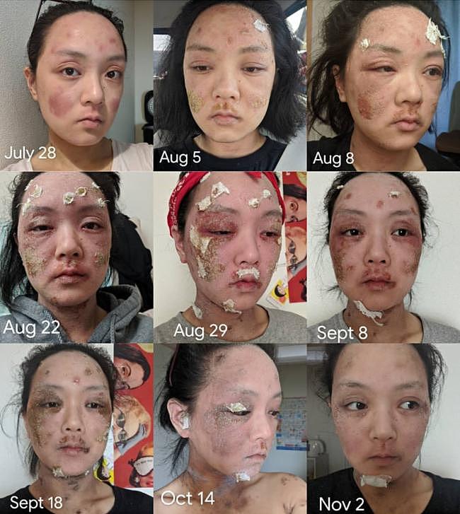 Belle documented her severe topical steroid withdrawal (TSW) after she stopped using the prescribed cream.