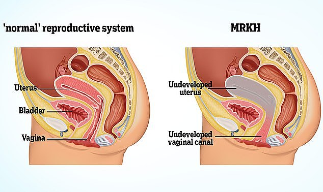 罗基坦斯基综合症，或 MRKH (Mayer Rokitansky Küster Hauser)，是一种先天性异常，其特征是阴道、子宫和子宫颈缺失
