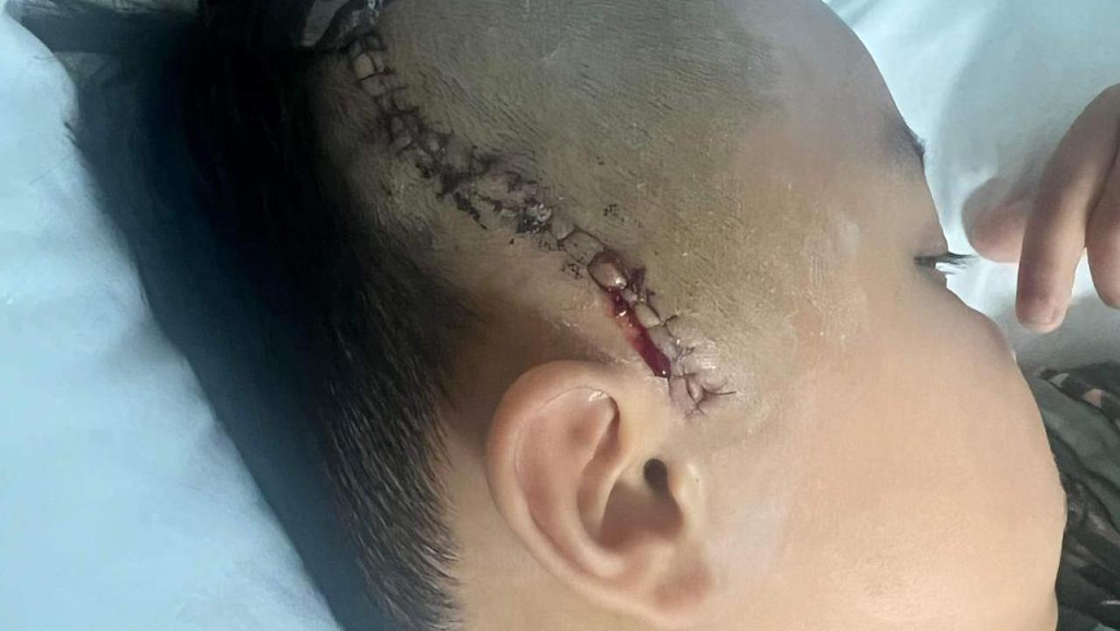 维州亚裔男孩遭同学打掉牙，几天后脑出血紧急送医！父母狠批校方“不负责”（组图） - 3