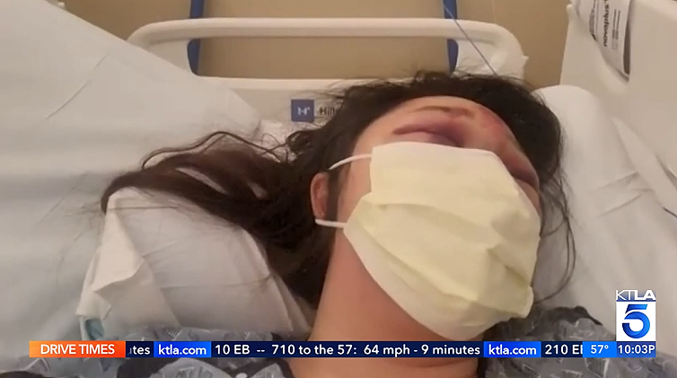 37岁华人女子在Costco遇袭：惨遭殴打+拖行数十米！头部受创，面部骨折撕裂（组图） - 4