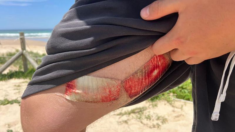 新州青年冲浪突遭鲨鱼攻击！侥幸逃过一劫，腿上落下瘆人的“血窟窿”（组图） - 2