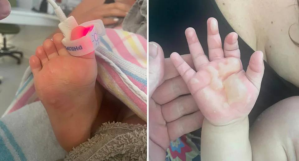 Toddler's burns on hands and feet