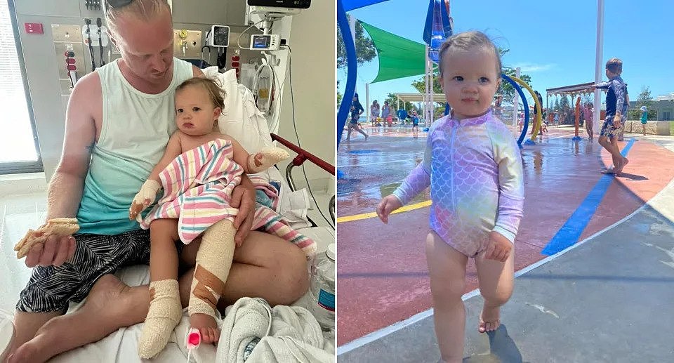 Toddler's suffers burns on arms and legs after playground injury 