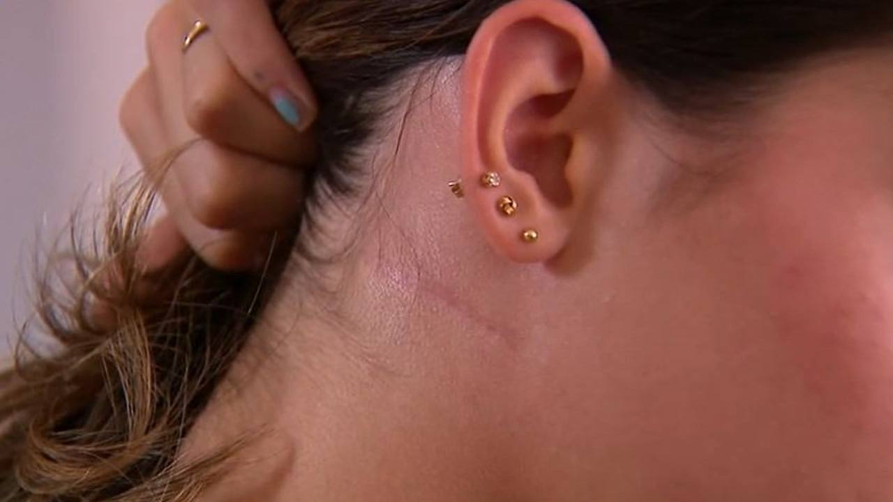 The 16-year-old said the scars are a “constant reminder” of the “scary” ordeal. Picture: 9News