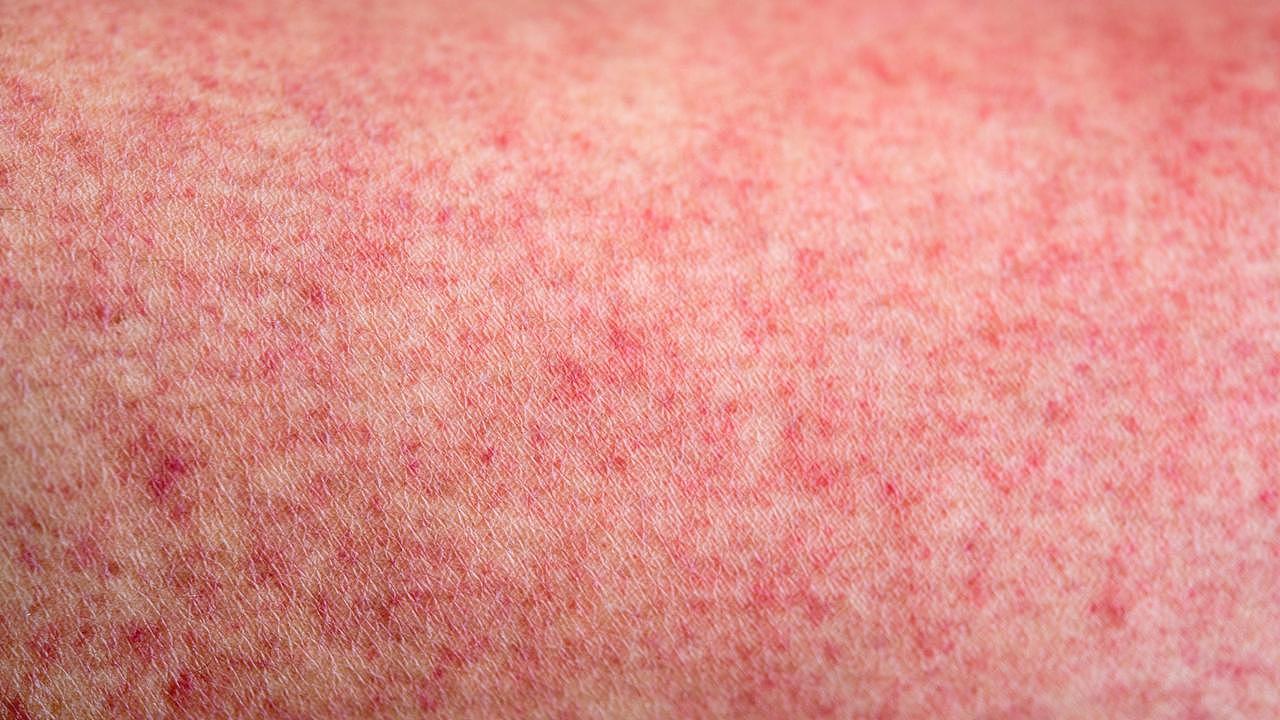 A common symptom of measles includes a red, blotchy rash spreading from the head to the rest of the body. Picture: Supplied