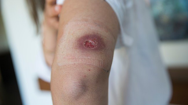 Cases of Buruli ulcer have reached record levels in Victoria. Picture: Paul Jeffers/The Australian