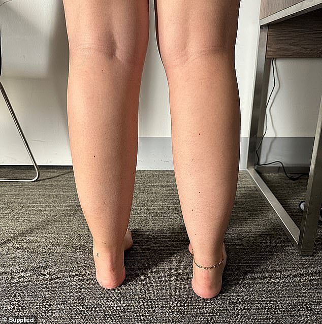 Lois' legs pictured: Blood clots aren't always visible from the surface, so it's essential to see a doctor if symptoms persist. The chance of blood clots are higher after flying due to the long periods of immobility and reduced air pressure