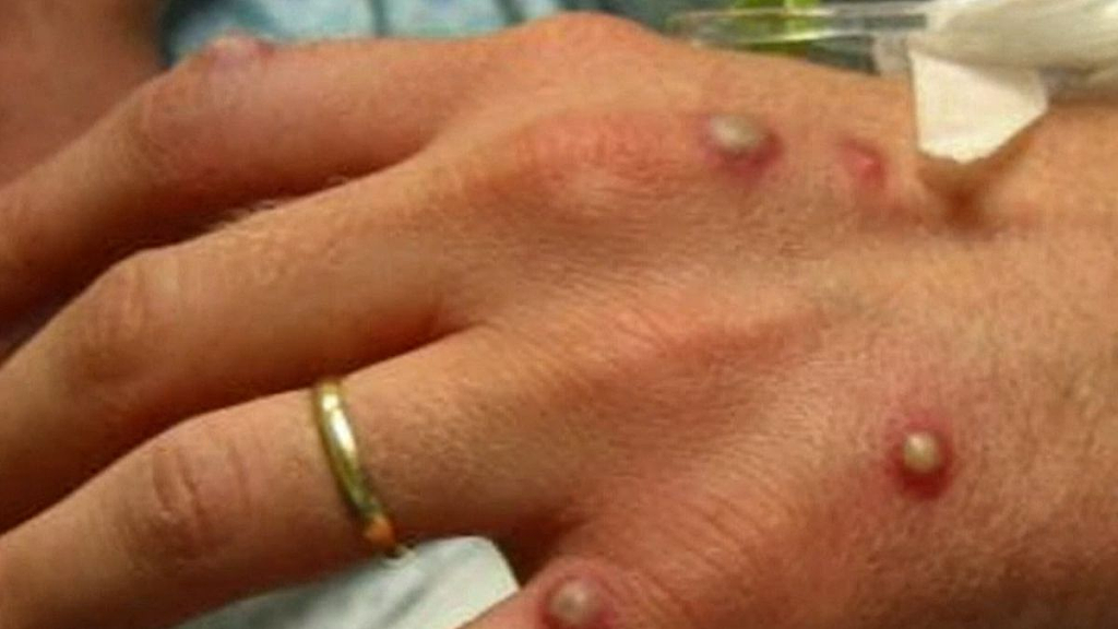 时隔半年，维州再次出现“猴痘”病例！卫生厅发警告（组图） - 3