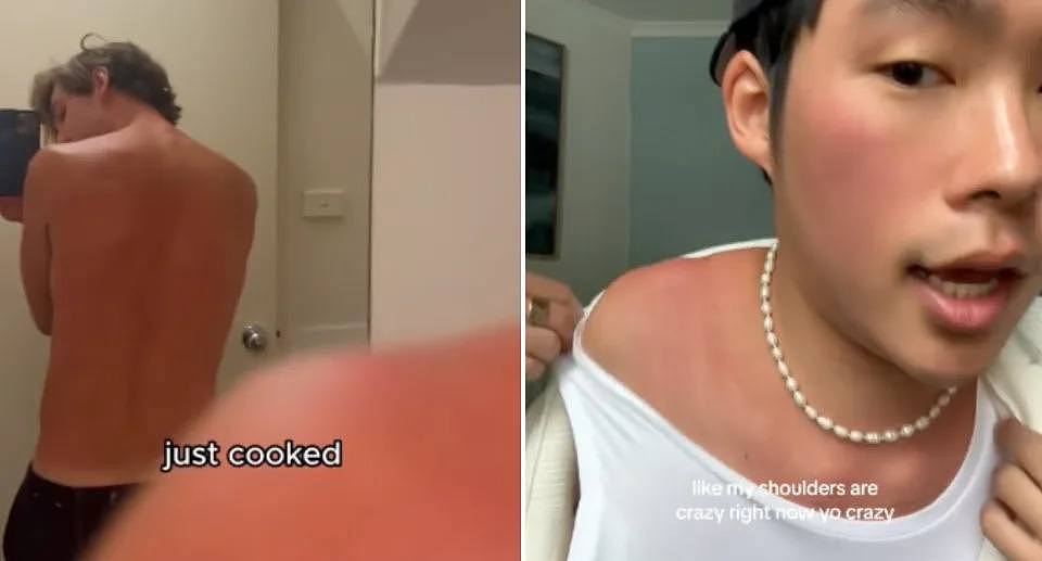 Two images of travellers red and sunburned after being in the Australian sun.