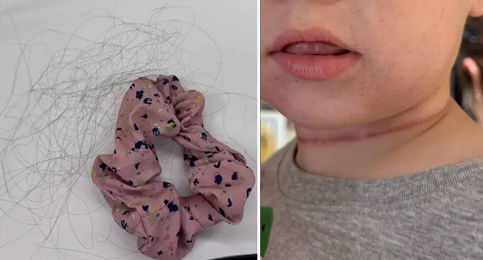 Left, the mum's hair tie with clumps of hair tangled in it. Right, the one year old has a tight strangulation mark wrapped around his neck after being strangled by his mum's hair.